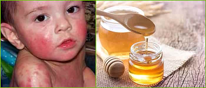 Как определить наличие аллергии на мед во взрослом или детском возрасте: причины, симптоматика, лечение, профилактика