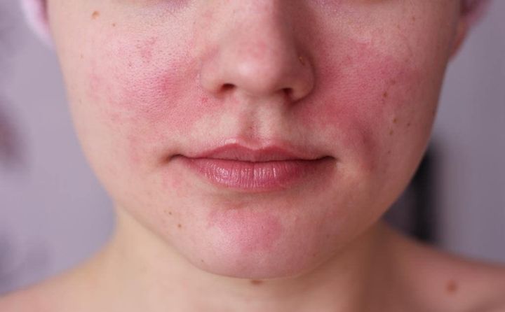 Как отличить аллергию от раздражения у ребенка