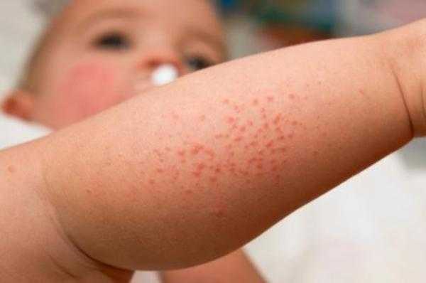 Как отличить аллергию от раздражения у ребенка