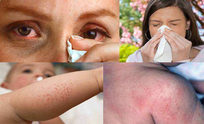 как отличить чесотку от аллергии и дерматита