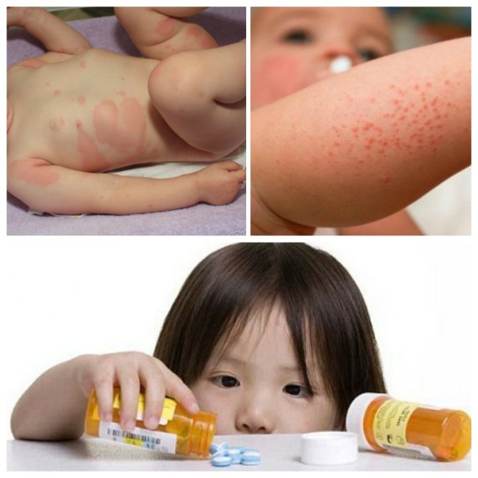 Как проявляется аллергия на антибиотики у ребенка