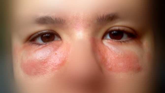как проявляется аллергия под глазами