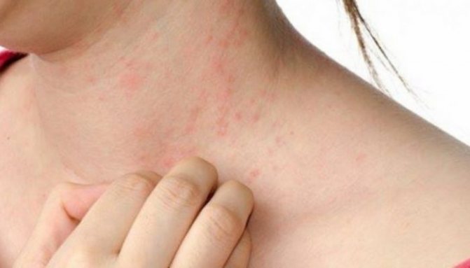 Как проявляется поливалентная аллергия? Основные симптомы и тактика лечения