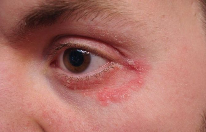 Как выглядит аллергия на глазах