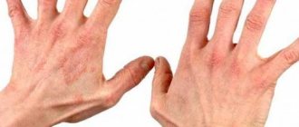 Кисти рук, пораженные дерматитом