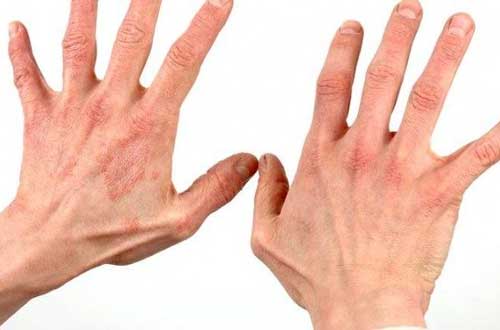 Кисти рук, пораженные дерматитом