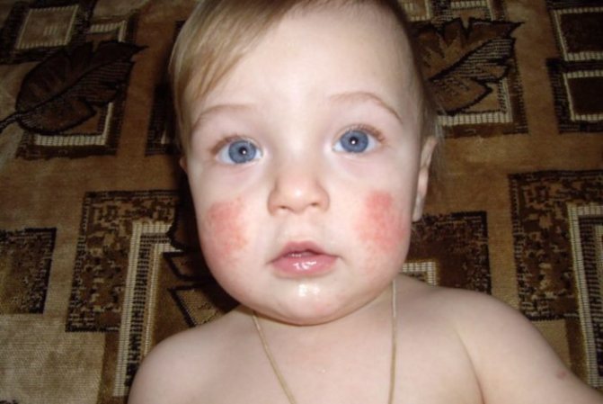 Контактный дерматит на лице ребенка фото