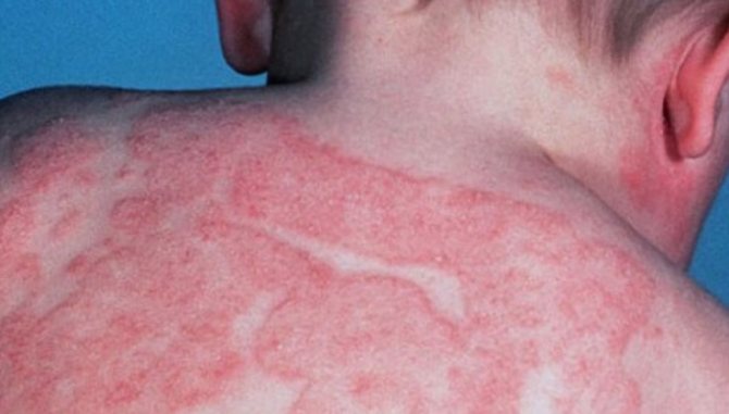 Контактный дерматит у ребенка на спине фото