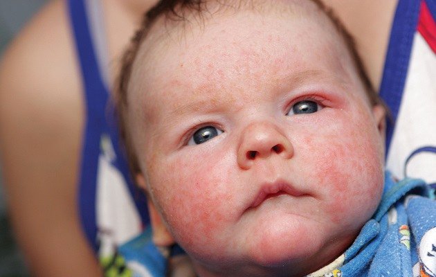 skin rash in baby