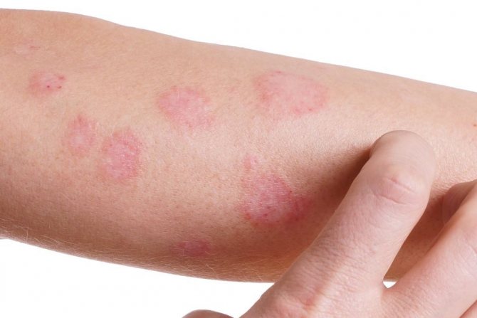 Skin rashes may be a side effect