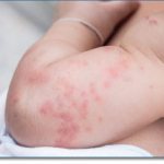 Urticaria in children