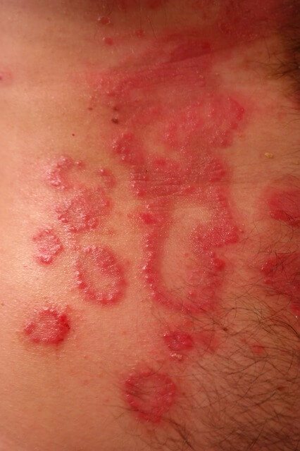 red spots on the surface of the skin