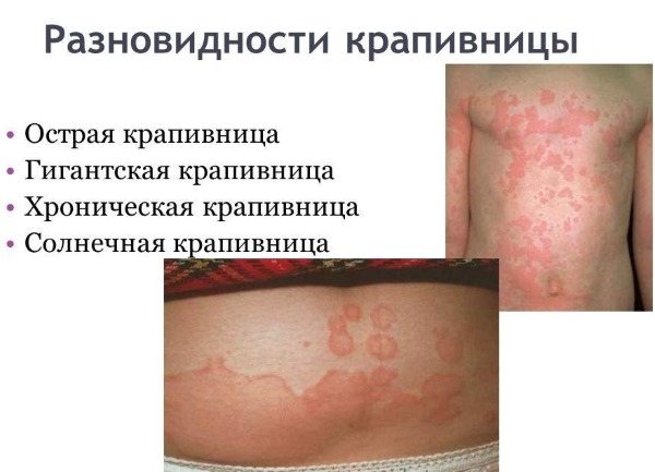 Красные пятна на теле у ребенка: шершавые, шелушащиеся, чешущиеся, как укусы, аллергия, чем мазать