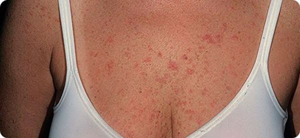Red spots in the chest area: causes and treatment