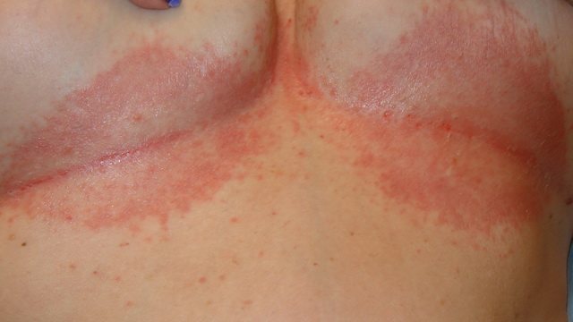 Red spots in the chest area: causes and treatment