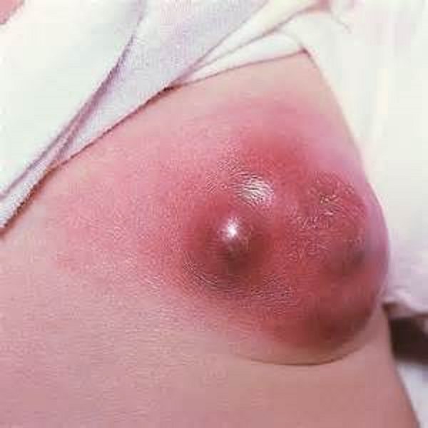 Красные пятна в области груди: причины и лечение