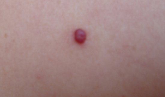 Red spots in the chest area