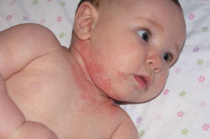 Лечение атопического дерматита у детей: что рекомендует доктор Комаровский?