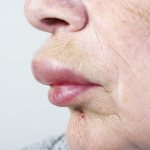 Локальный аллергический отек верхней губы является местным проявлением общей реакции