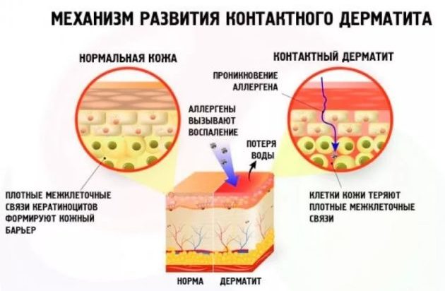 Механизм контактного дерматита