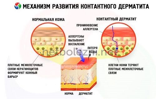 Механизм развития контактного дерматита