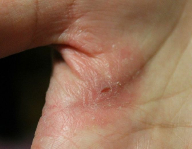 Microbial eczema on the palm