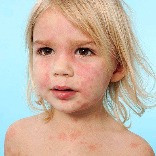 может быть аллергия на хурму у ребенка