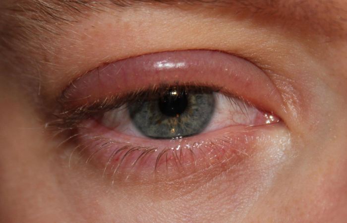 Отек глаз при аллергии