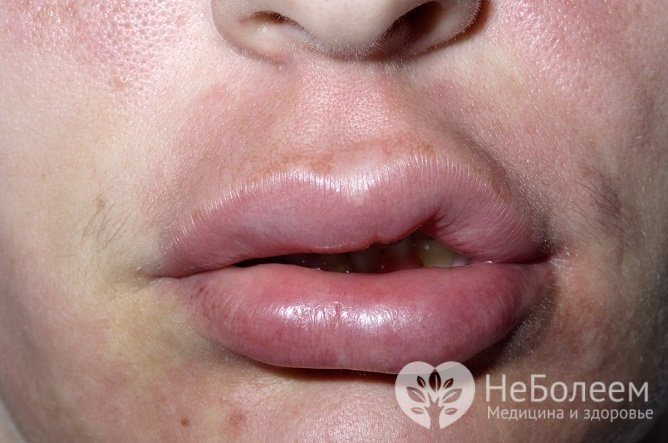 Отек губ может быть вызван разными причинами, от причины зависит лечебная тактика