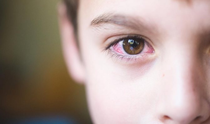 Отек век и покраснение глаз, обильное слезотечение, зуд, — признаки развития аллергического конъюнктивита у ребенка