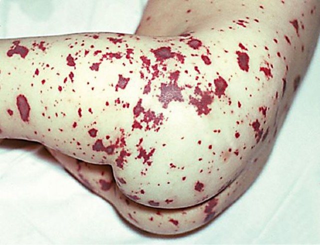Papular rash: treatment of patchy skin rashes in a child