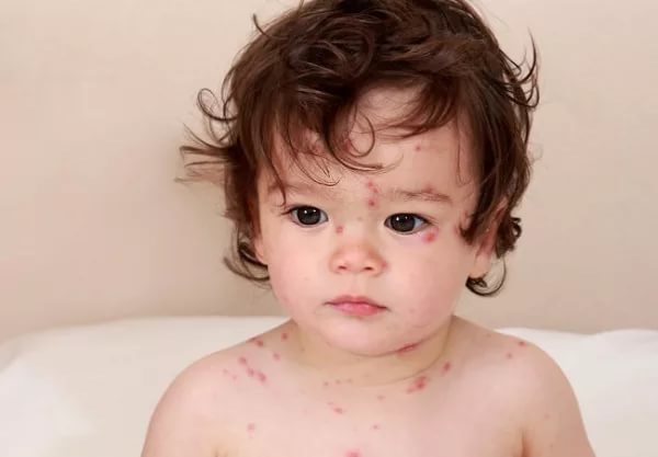 Papular rash: treatment of patchy skin rashes in a child