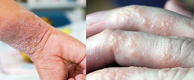 Покраснение кожи кистей рук у ребенка