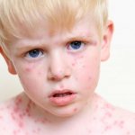 Причины и лечение псориаза у детей
