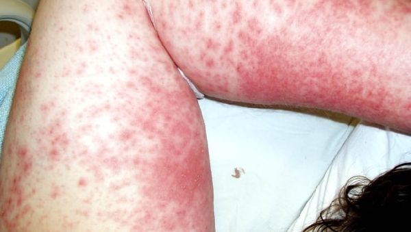 Причины токсико-аллергического дерматита