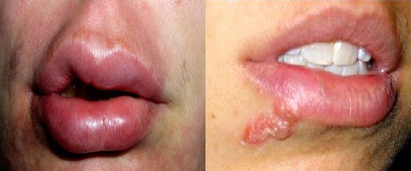 признаки аллергии вокруг рта