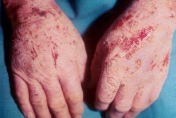 Признаки токсико-аллергического дерматита