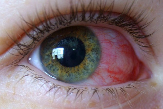Проведение лечения покраснения глаз начинается с избавления от искусственных ресниц