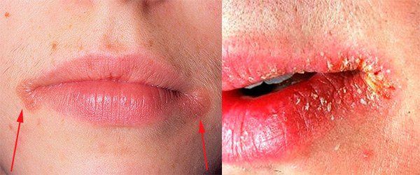 проявление аллергии в уголках губ