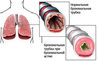 Проявление бронхиальной астмы