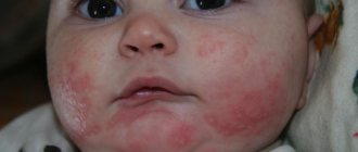 Псевдоаллергия у ребенка