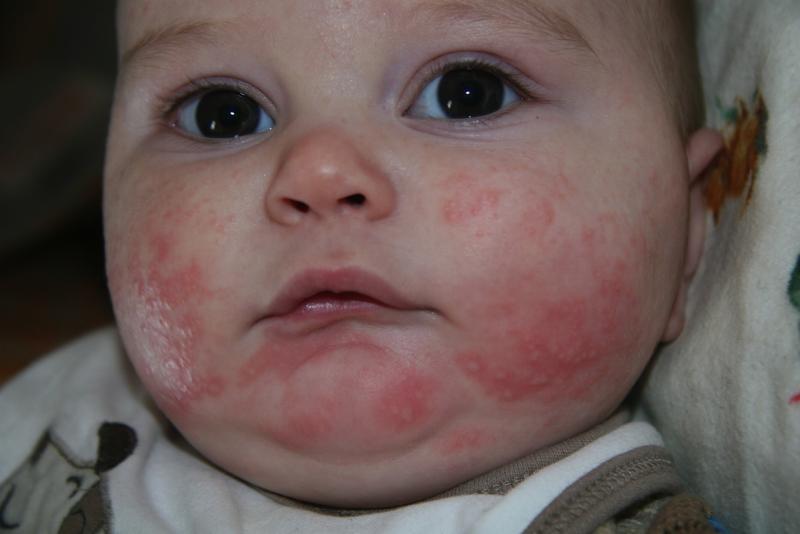 Псевдоаллергия у ребенка