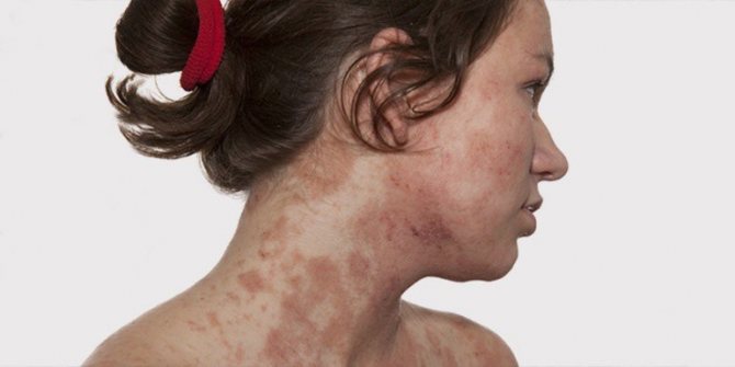 Psoriasis is inherited from parents to children