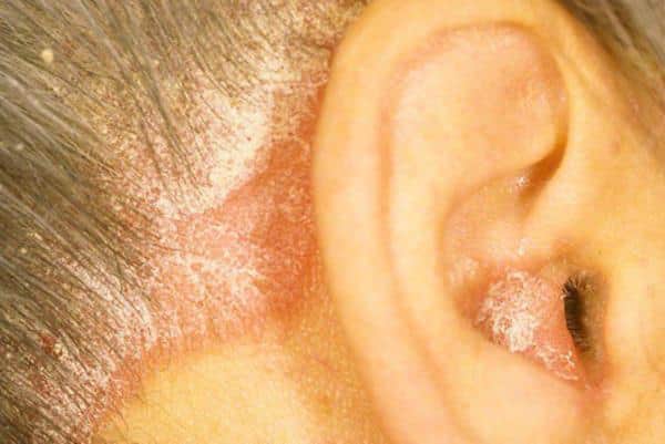 Seborrheic dermatitis in the ears