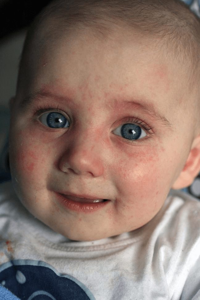 Сезонная аллергическая реакция на лице у ребенка