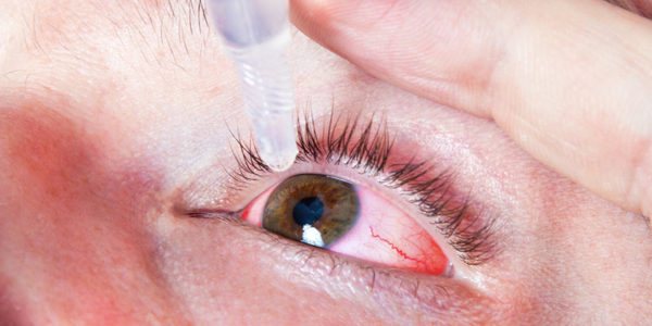 Симптоматический офтальмологический препарат для уменьшения красноты и отечности слизистой оболочки глаз.