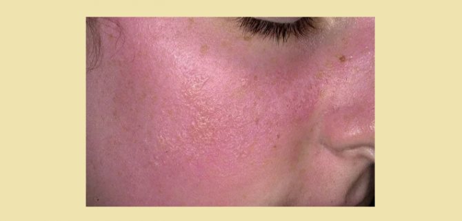 Симптомы аллергии на солнце: зуд, сыпь, красные пятна