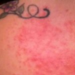 Симптомы аллергии на укусы клопов