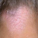 Симптомы, причины и лечение нейродермита на голове и лице