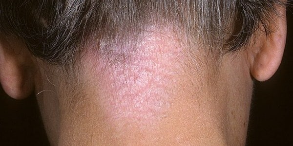 Симптомы, причины и лечение нейродермита на голове и лице